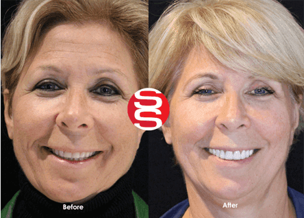 Porcelain Veneers